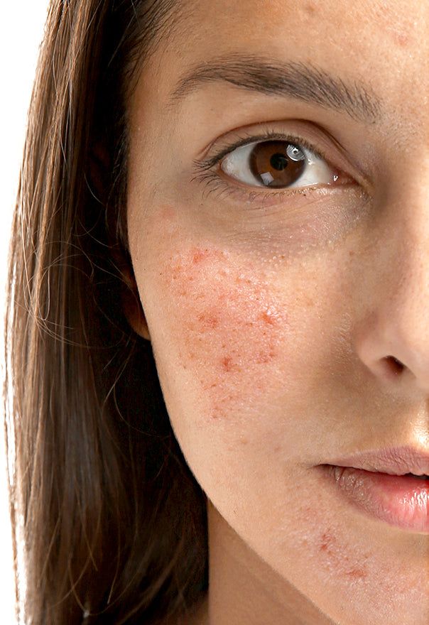 Kenapa Jerawat Muncul di Usia Dewasa?