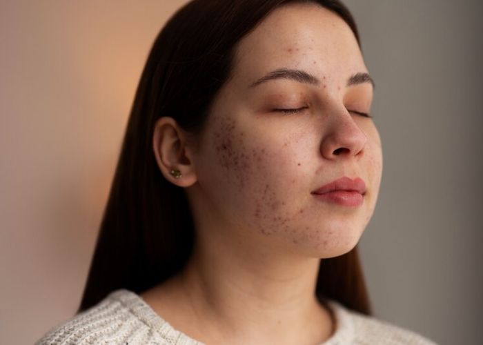 Jerawat Bikin Kulit Merah Meradang? Begini Cara Mengatasinya dengan Aman!