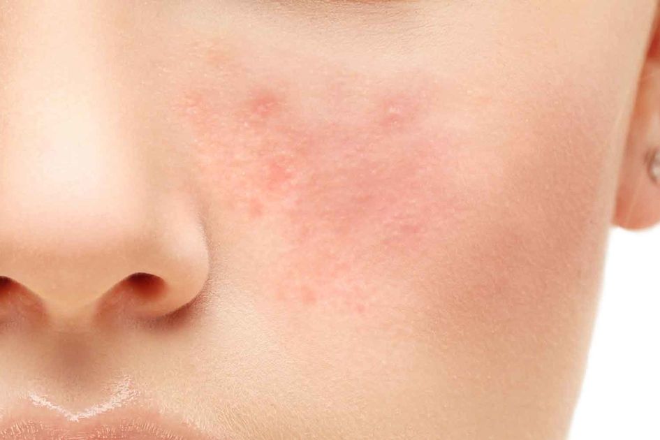 7 Penyebab Utama Peradangan dan Inflamasi Kulit yang Wajib Anda Ketahui