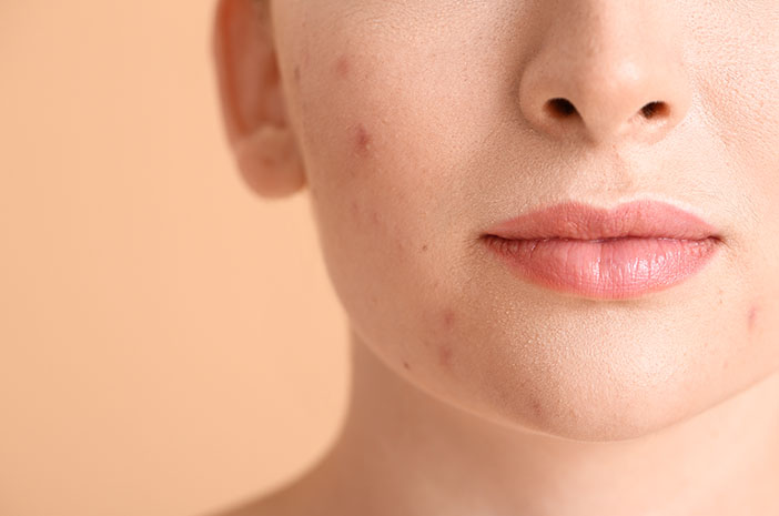 Kulit Berjerawat? Ini Treatment yang Bisa Kamu Coba untuk Mengatasinya