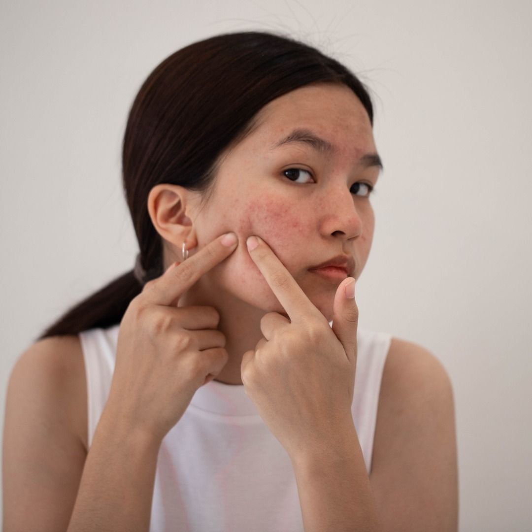 Cara Menghilangkan Acne Scar Secara Profesional