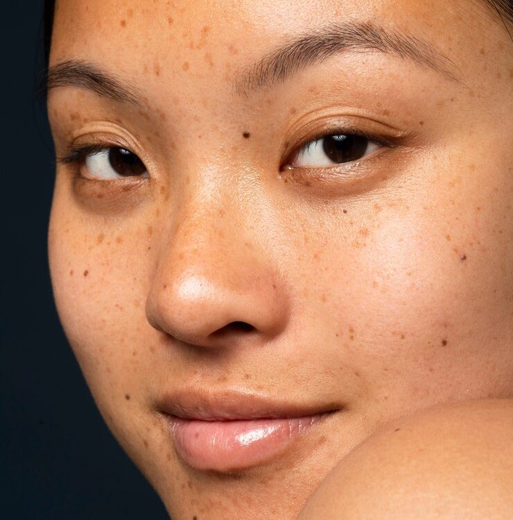 Cara Menghilangkan Noda dan Bintik Hitam di Wajah Secara Efektif