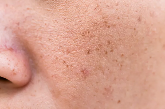 Dekat Rumah dan Cocok di Kulit: Review Jujur Treatment Flek Hitam di Reglow Clinic