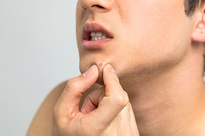 Facial Hydra Acne: Solusi Aman Atasi Jerawat Puber untuk Remaja