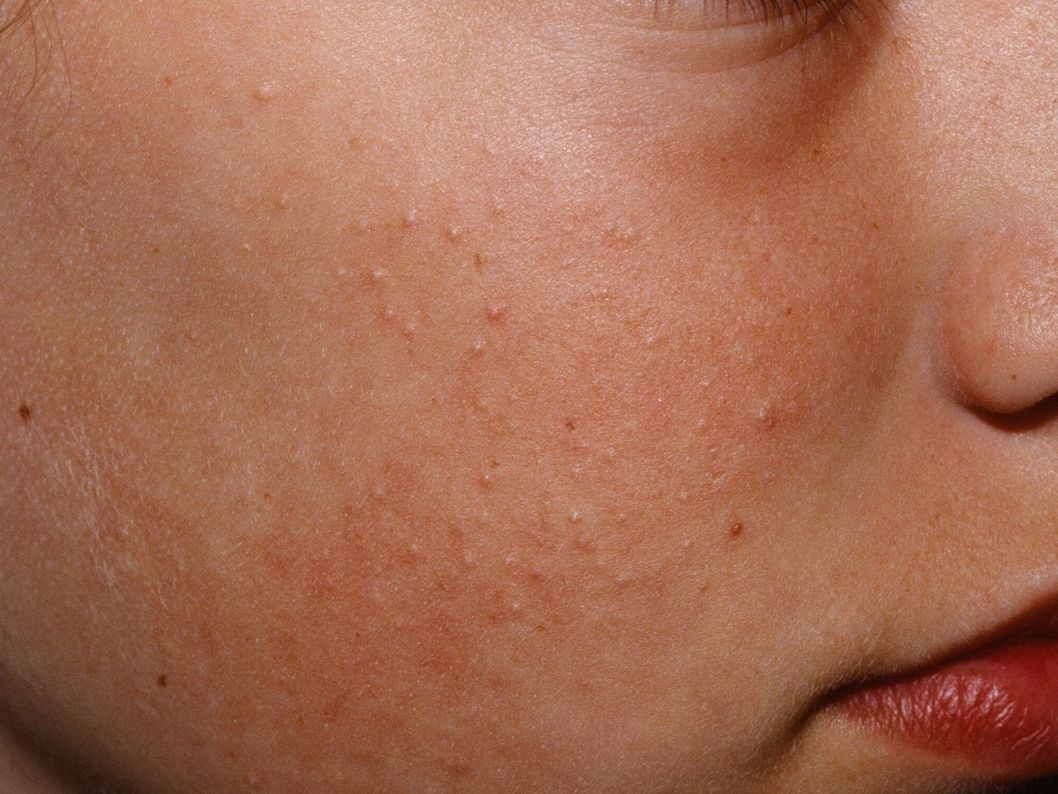 Cara Menghilangkan Tekstur Kulit Ayam di Wajah Secara Alami dan Efektif