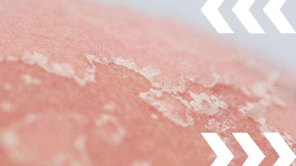 Kulit Kusam? Kenali Penyebab Munculnya Sel Kulit Mati di Wajah